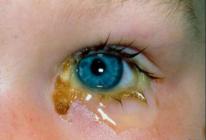 Вигамокс глазные капли как снять аллергию