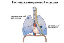 Tamponi di ossigeno per il cancro ai polmoni