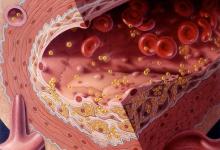 LDL cholesterol is elevated: what does it mean and how to reduce it?