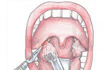 Causes and symptoms of tonsil cancer