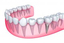Riparazione dentale: come inserire un'arcata nell'ultimo attacco?