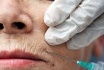 बोटोक्स के साथ होंठ वृद्धि: प्रभावशीलता और नुकसान