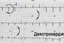 ECG con posizionamento degli elettrodi destrocardici